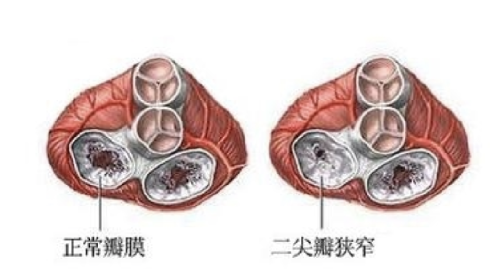 常见心脏瓣膜病病变分类和外科手术方式