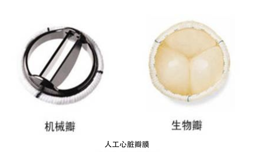 人工心脏瓣膜分类及特点